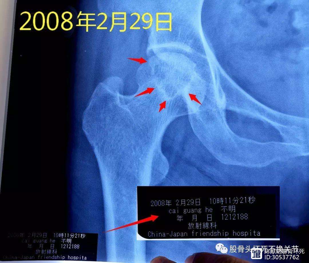 营口人工骨头医保报销多少(人工骨头医保报销多少比例)